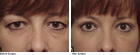 Blepharoplasty surgeon Springfield MA