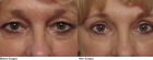 eye lifts in western MA