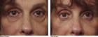 Blepharoplasty in western MA