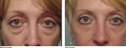 eye lifts for women