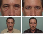 Blepharoplasty