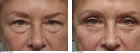 women's Blepharoplasty MA