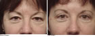 eye lift MA