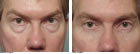 men's Blepharoplasty