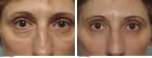 Northampton Blepharoplasty surgeon