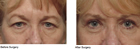 Northampton eye lift surgeon