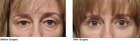 western MA Blepharoplasty