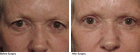 Allcroft Eye Lift Surgery