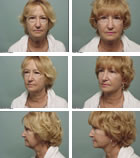 facelift Rhytidectomy