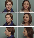 Rhinoplasty surgeon MA