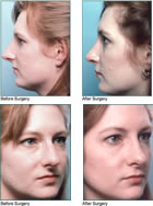 Rhinoplasty MA