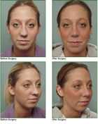 Rhinoplasty western MA