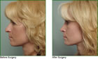 Rhinoplasty