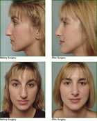 Rhinoplasty MA