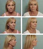 Facelift Surgery MA